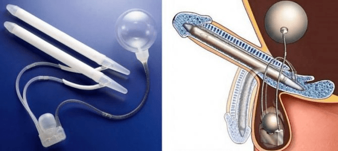 phaloprosthetics pre zväčšenie penisu