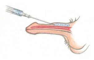 Injekcia kyseliny hyalurónovej pod kožu, aby bol penis hrubší