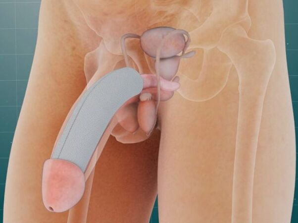Penis po zavedení špeciálneho implantátu pod kožu