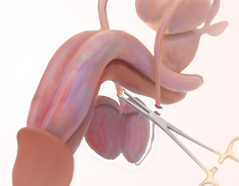ligamentotómia na zväčšenie penisu