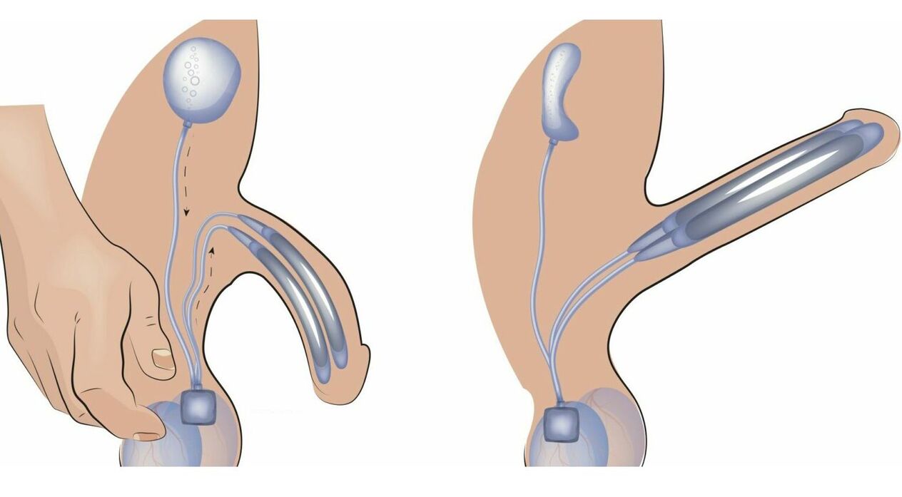 protéza penisu na zväčšenie penisu